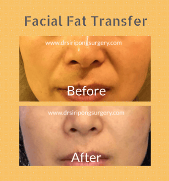 Slider image (2) Dr. Siripong Plastic Surgery in Thailand